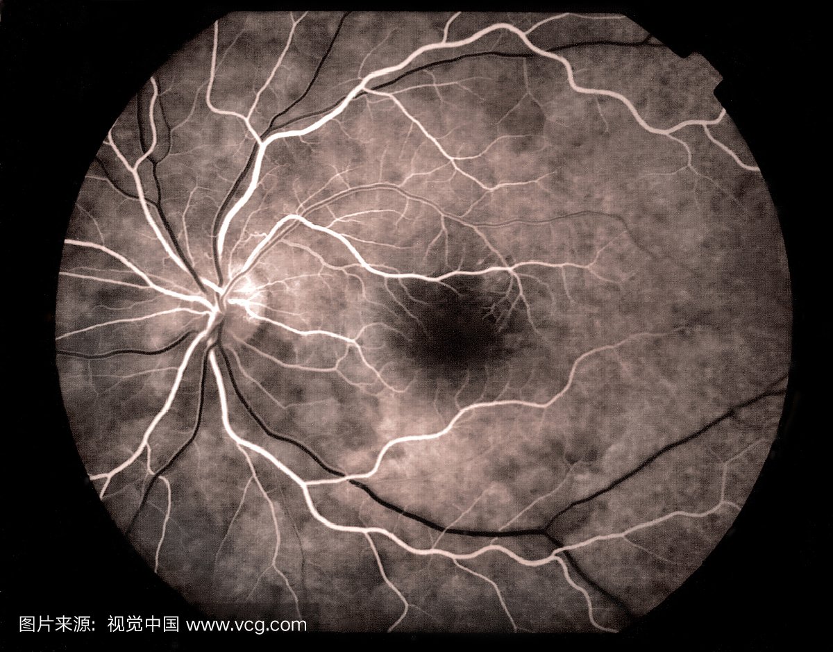 视网膜的荧光素(或荧光)血管造影检查显示视网