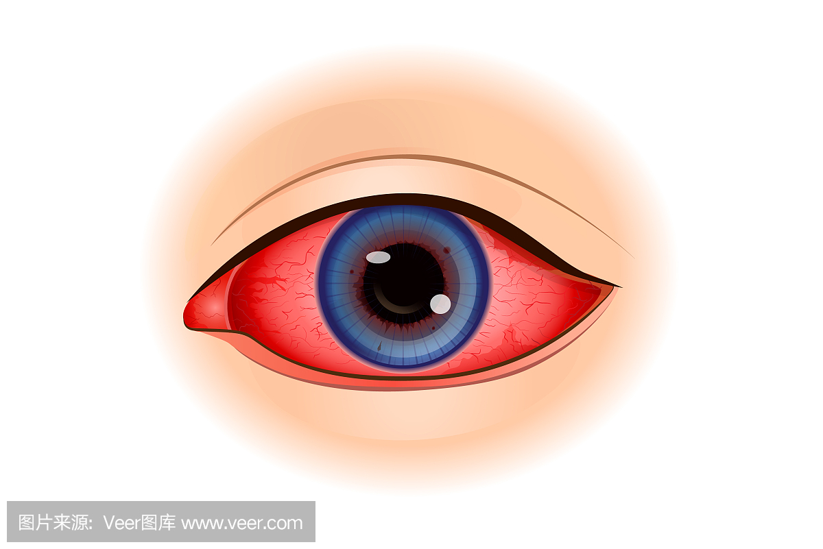 葡萄膜炎症状或眼睛炎症。