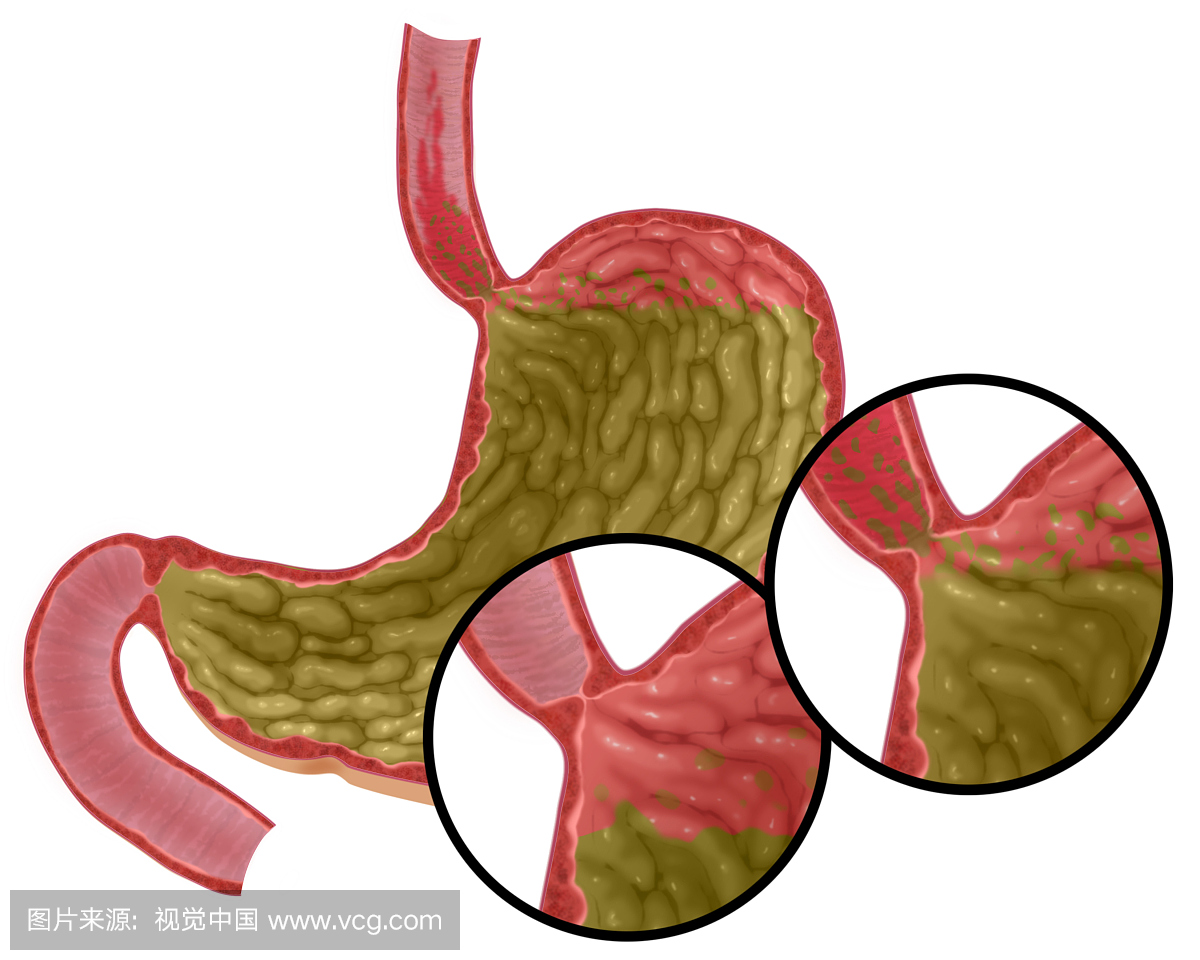 胃酸反流或胃食管反流病(GERD)的图示。插图