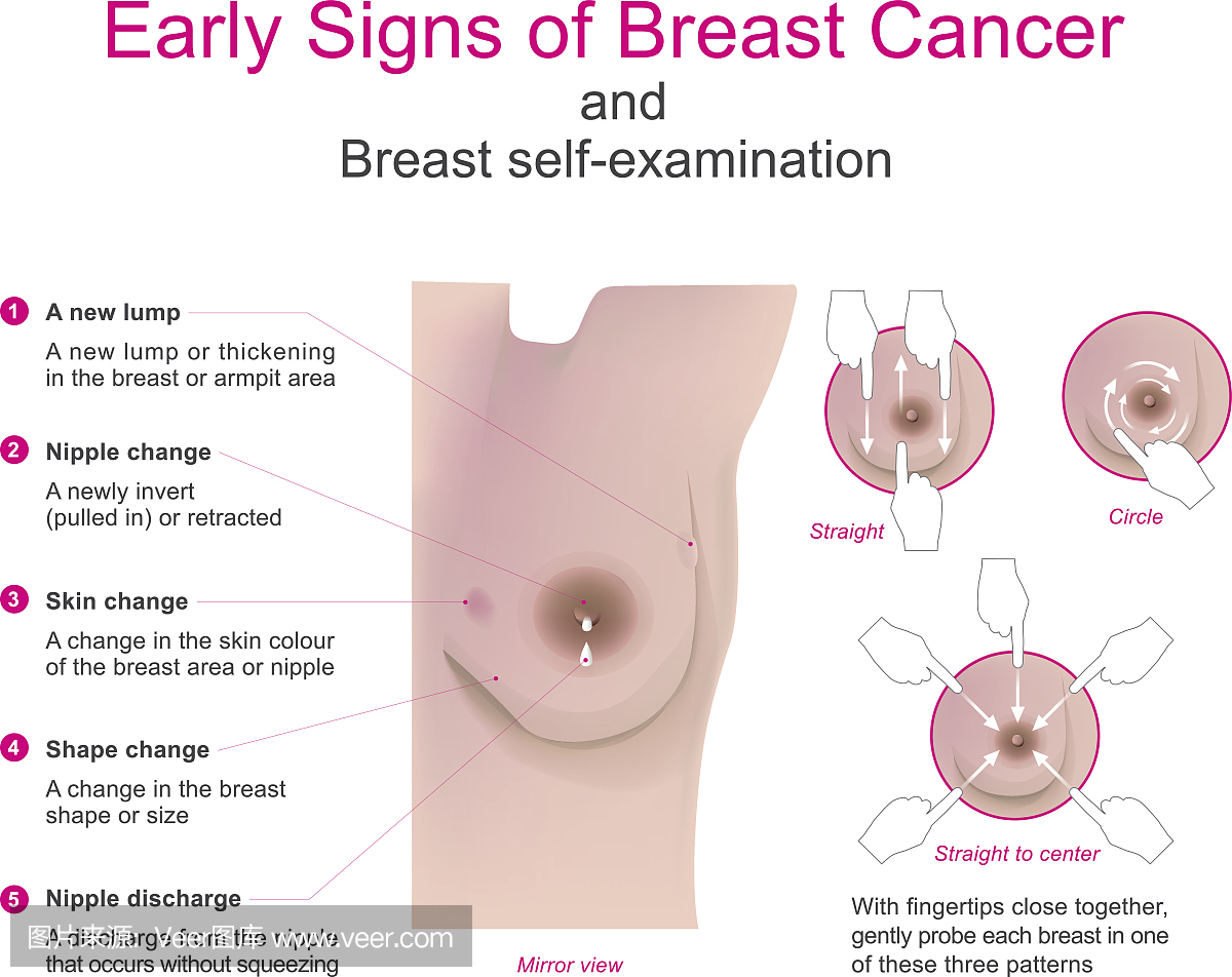 乳腺癌早期症状和乳房自检。