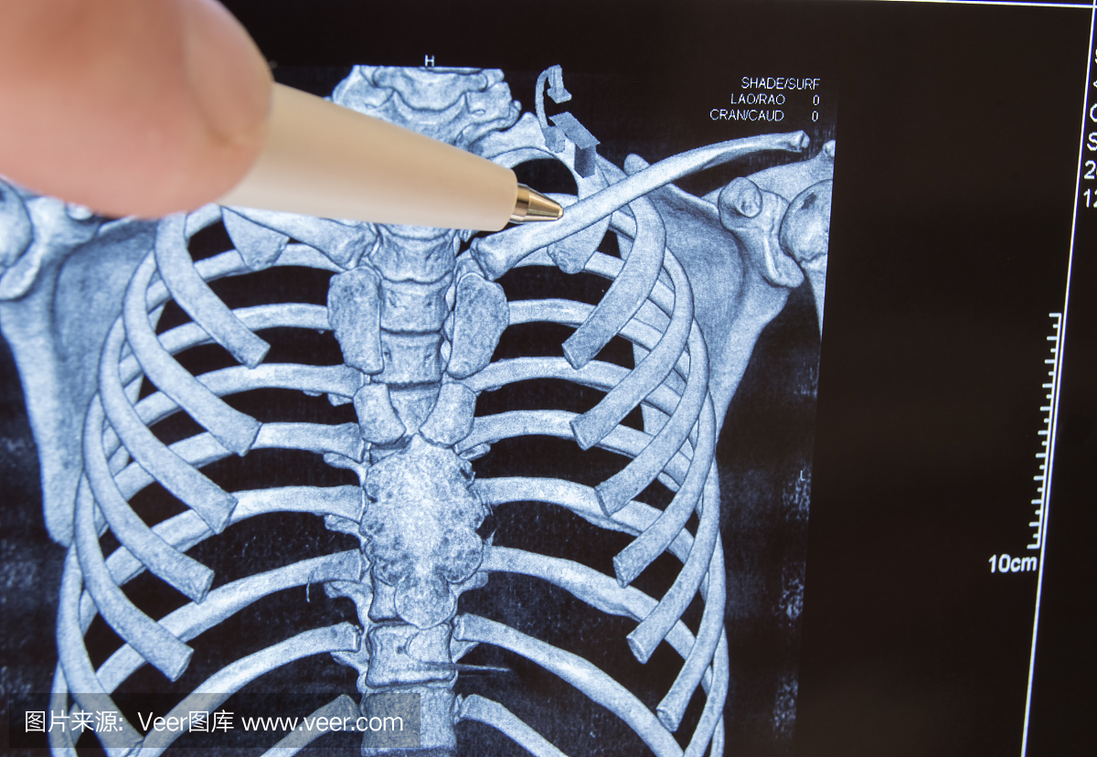 医生在3D电脑断层扫描图片中指出锁骨上的钢