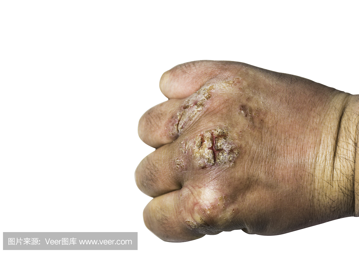 关闭湿疹或牛皮癣手上皮肤与开放的伤口,皮和