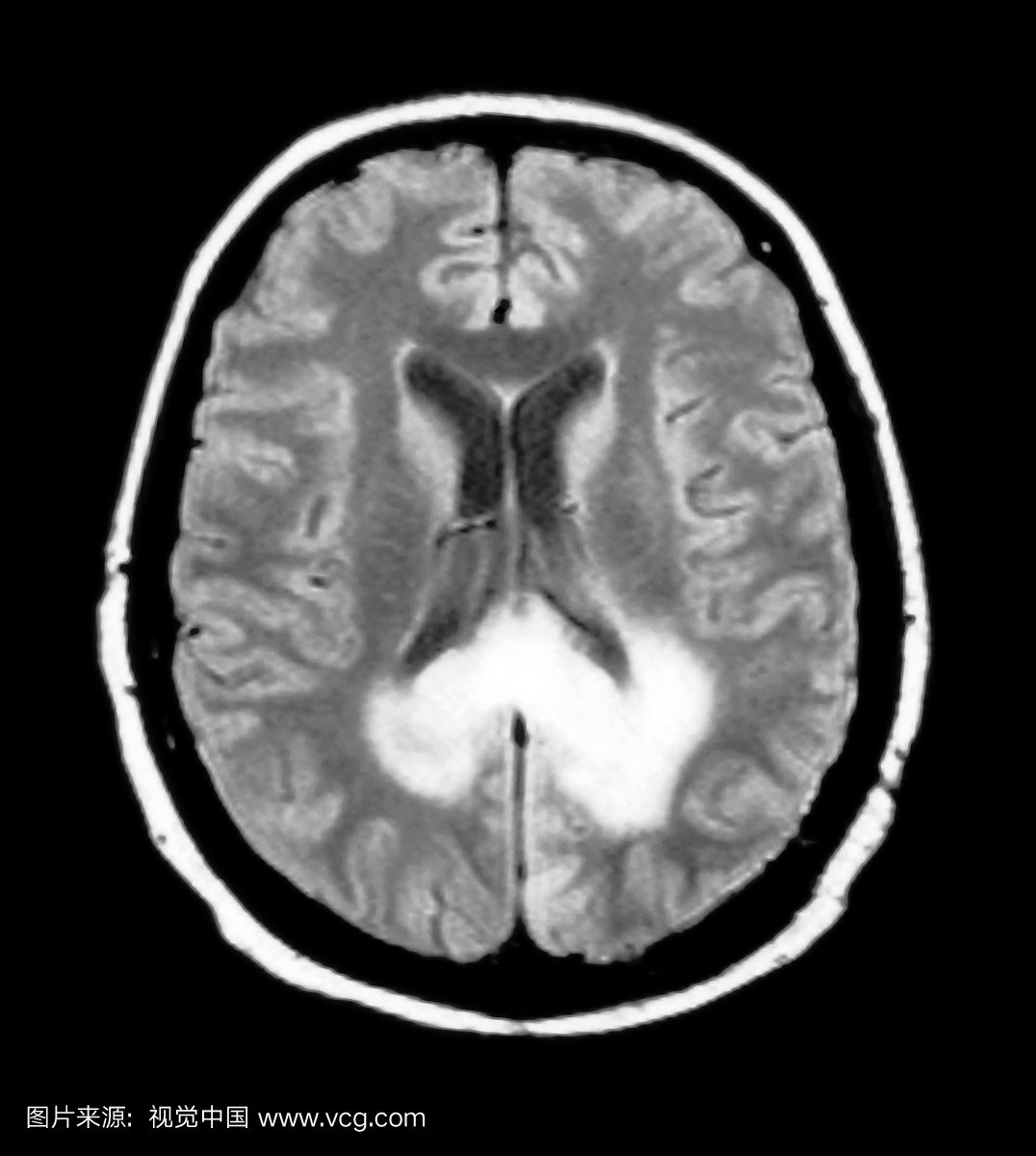 这种对比度增强的大脑轴向(横截面)MRI图像显