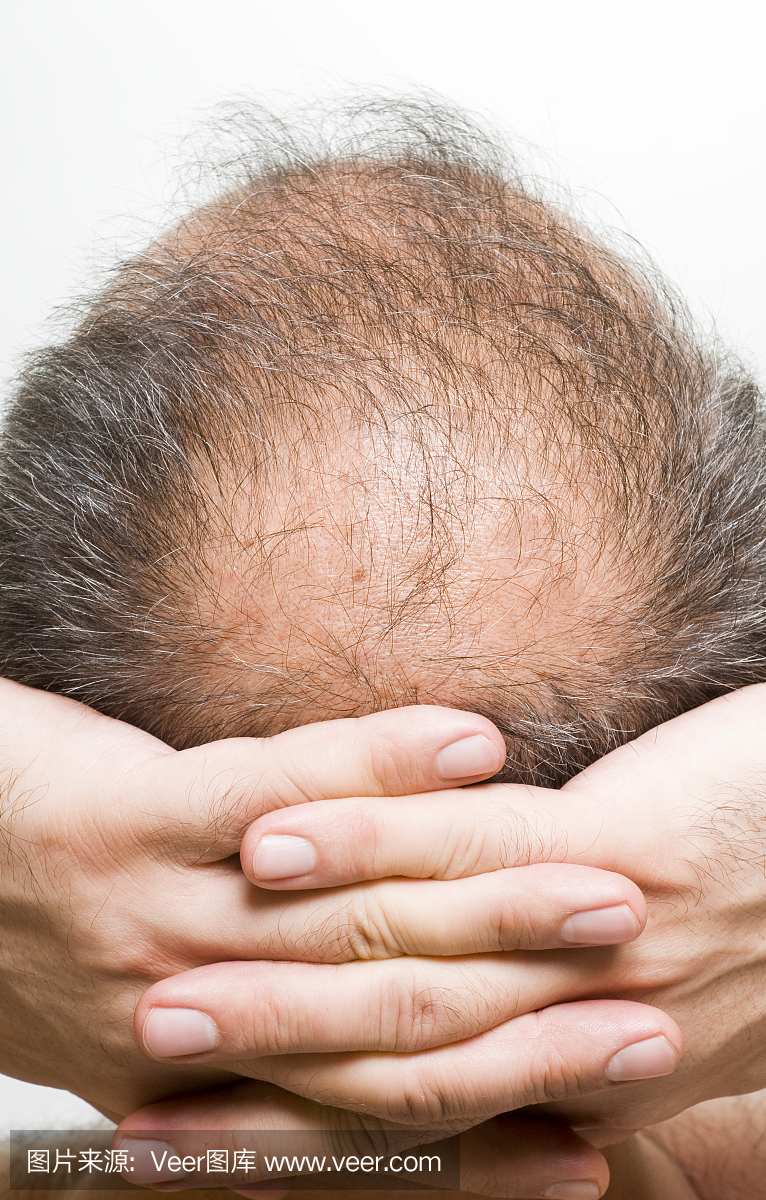 后脑勺,后脑,秃顶,谢顶