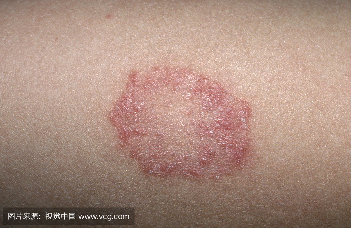 癣(tinea corporis)是由皮肤真菌感染引起的疾病
