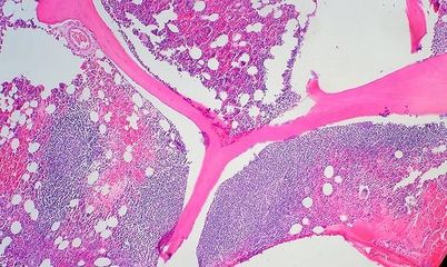 How Is a Bone Marrow Transplant Done? eHo How Is a Bone Marrow Transplant Done? eHo