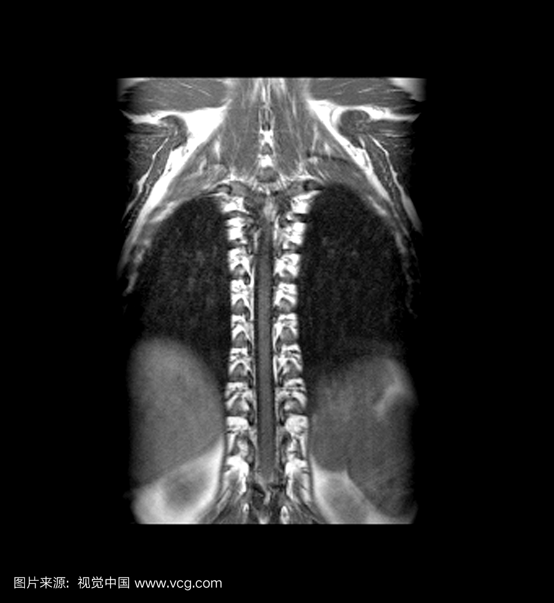 胸椎的冠状(正面)T1加权MRI图像,穿过椎管平面