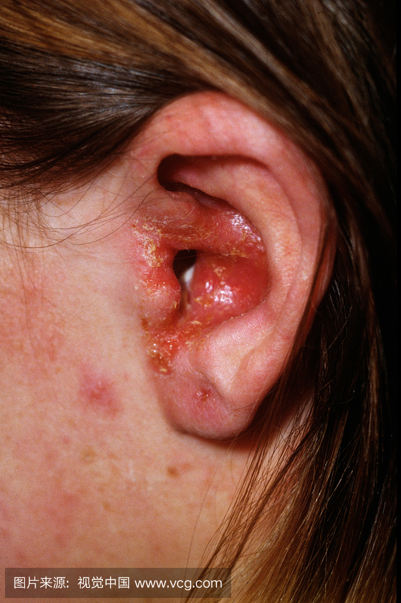严重外耳炎外耳道发炎,覆盖着扩张渗出液,渗透