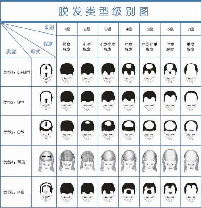 脱发的类型一般有哪些