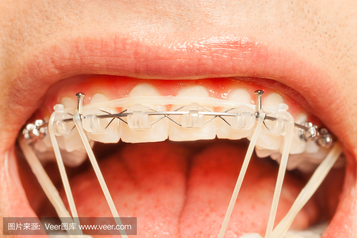 隐形矫治,隐形牙套,隐形矫正,透明牙套