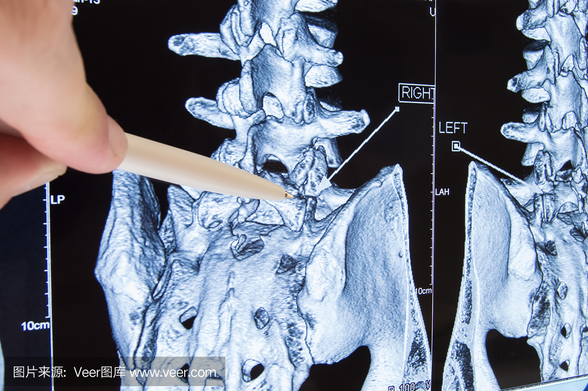 扫描腰骶脊柱。医生指出腰部区域检查病理,如