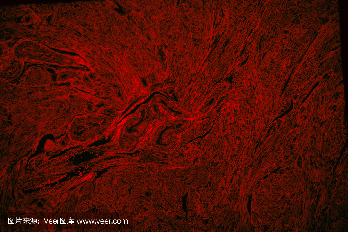 人平滑肌瘤子宫肿瘤组织的红色荧光