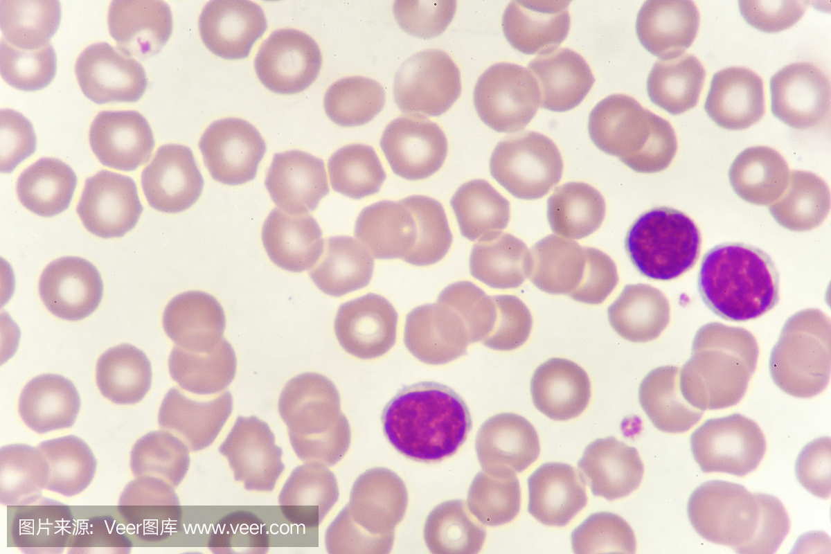 血涂片中的淋巴细胞