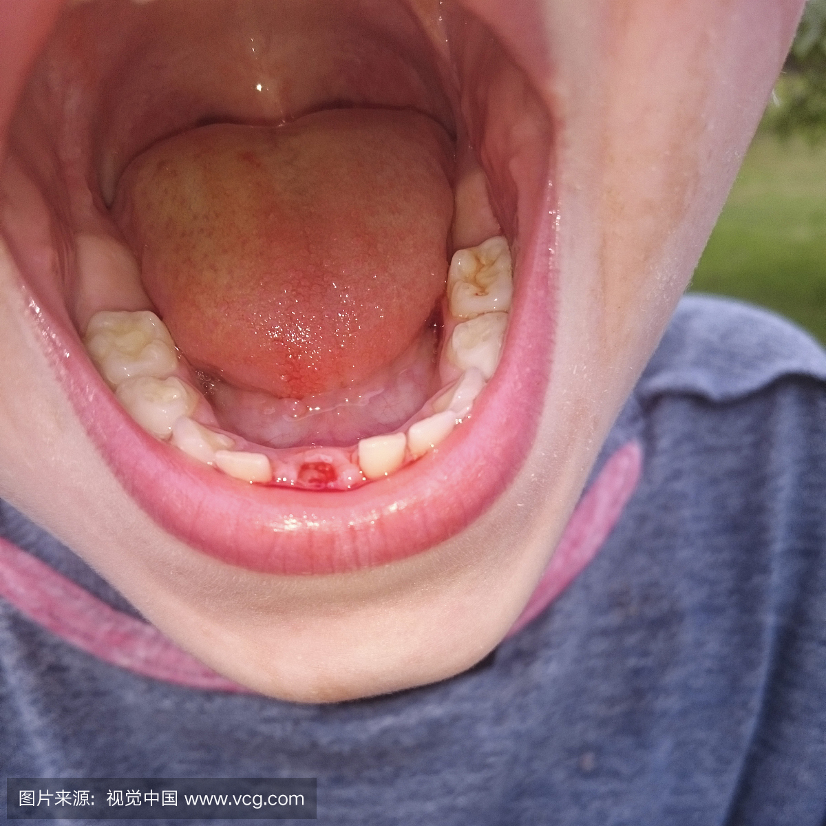 第一个宝宝牙齿丢了