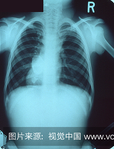 X线片显示小儿肺动脉高压,支气管扩张改变儿童