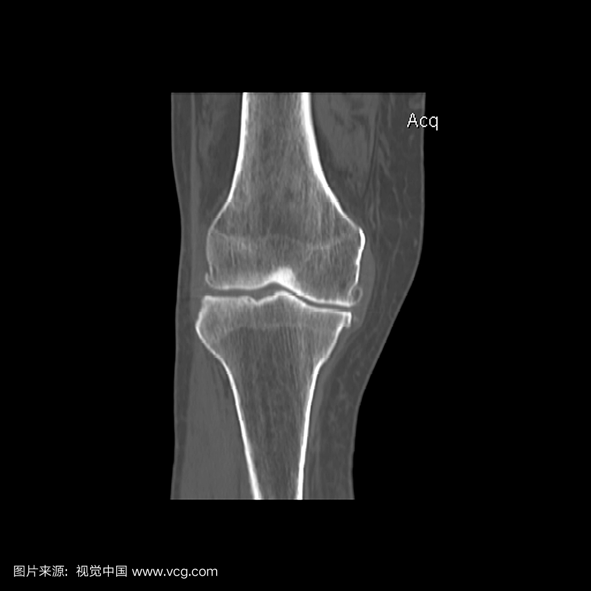 膝盖的冠状(正面)CT重建显示出广泛的骨质疏松