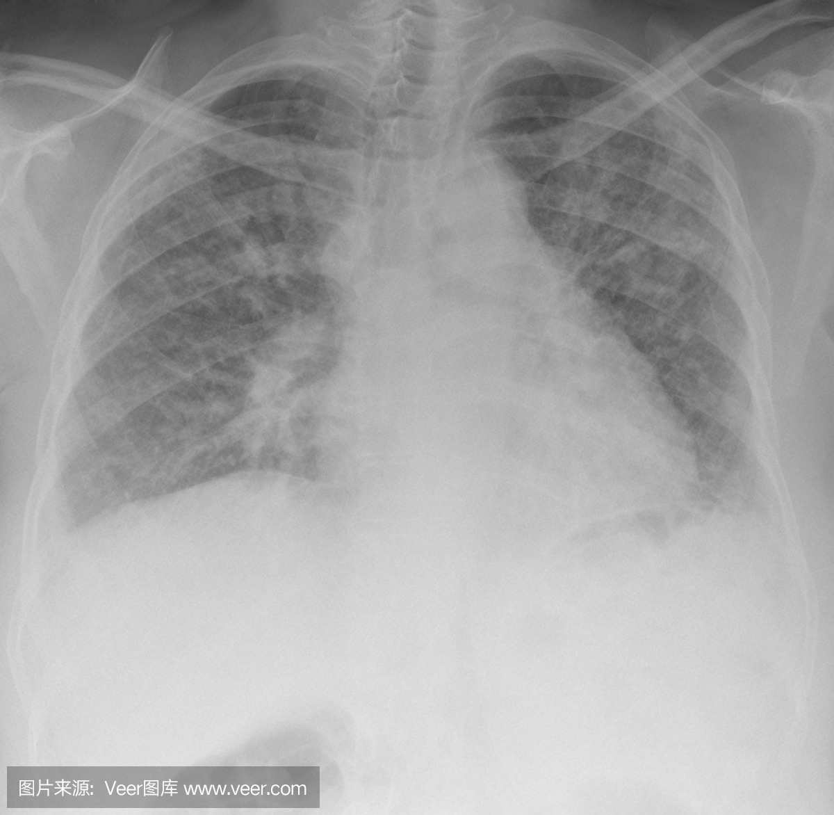 数字胸片严重肺纤维化