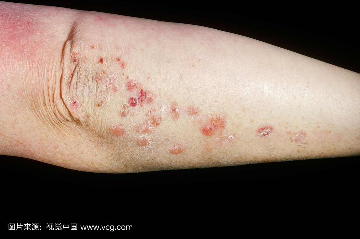 疱疹样皮炎,通常与乳糜泻相关的皮肤病。其名