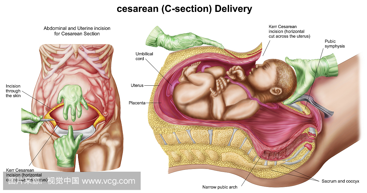 插图显示剖腹产胎儿。