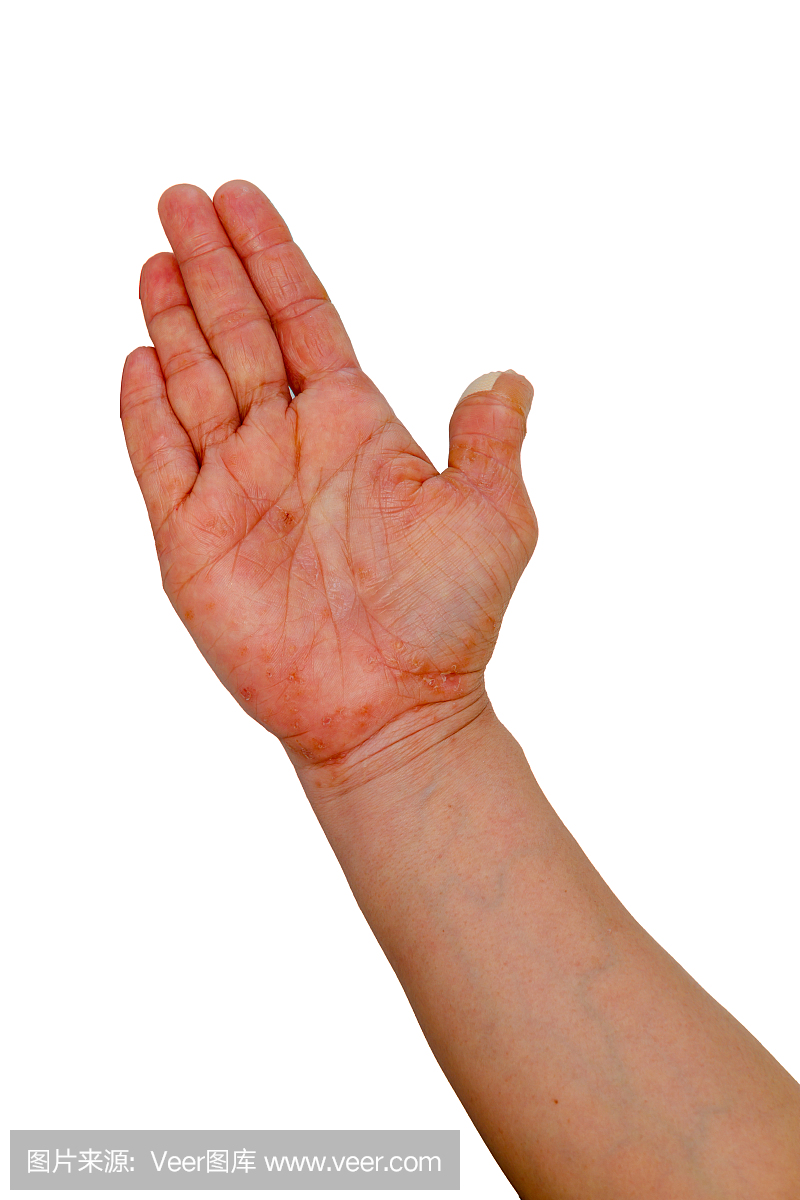 手与过敏引起的水泡隔离在白色背景上:Pomph