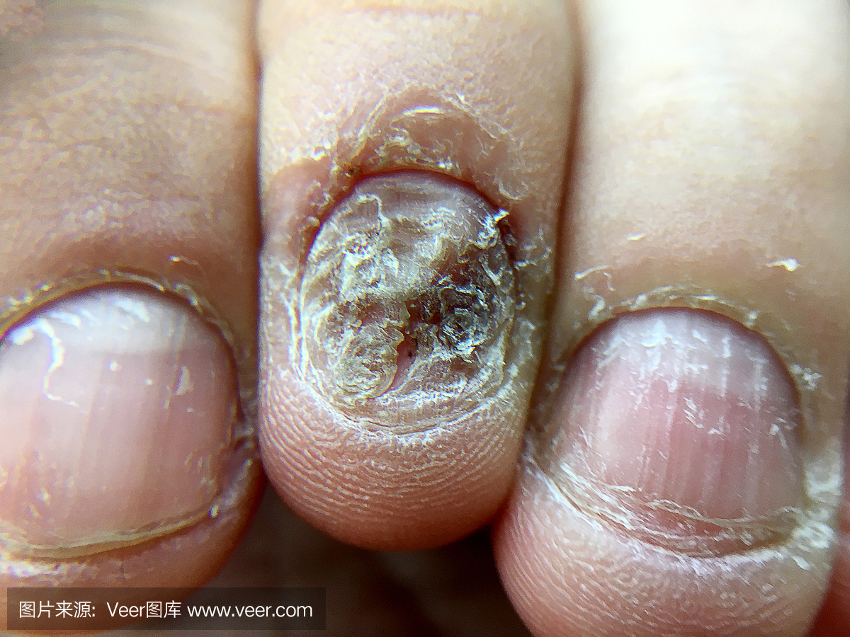 大关闭的真菌感染指甲手,手指与甲真菌病,指甲