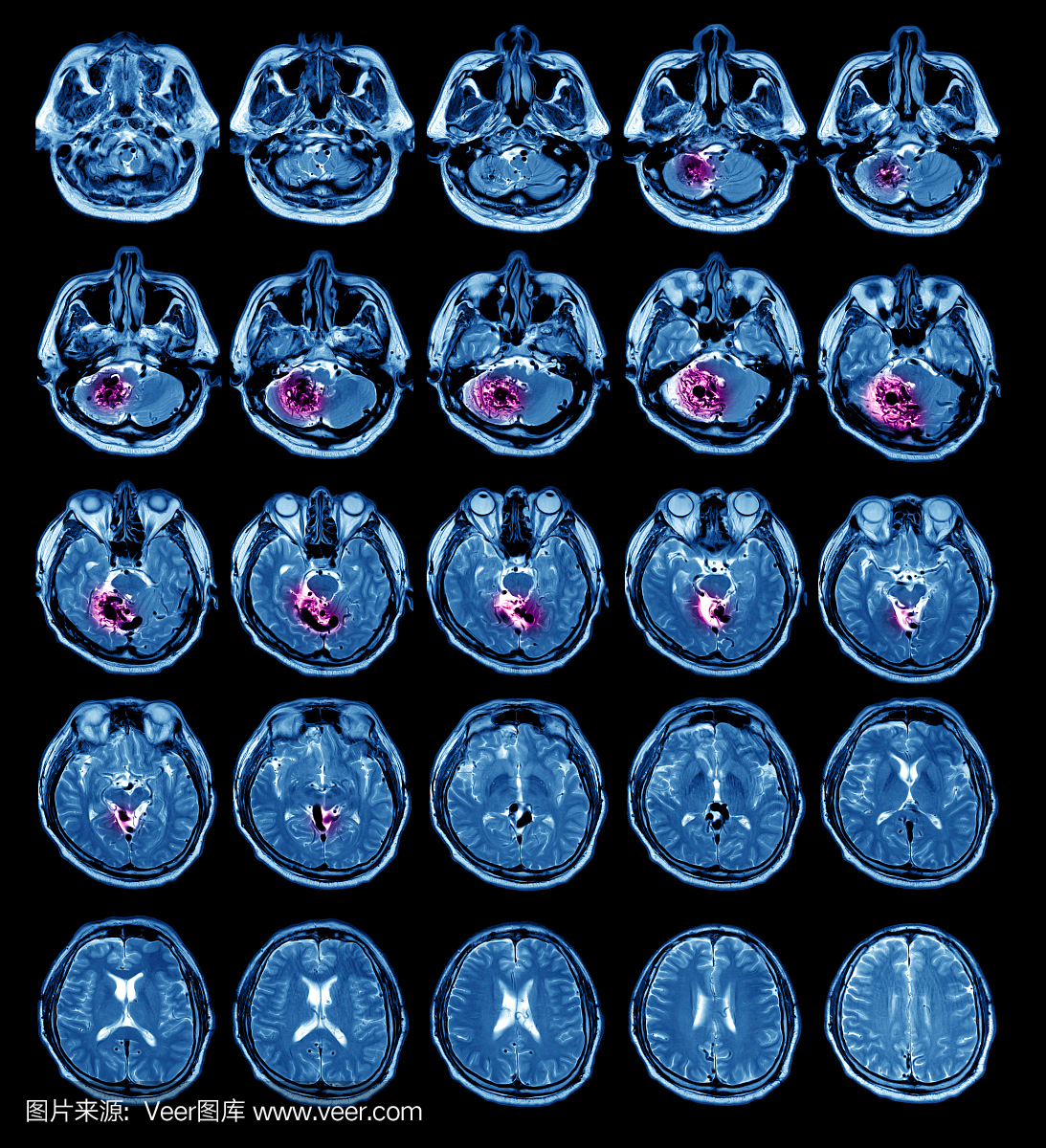 大脑MRI扫描图像