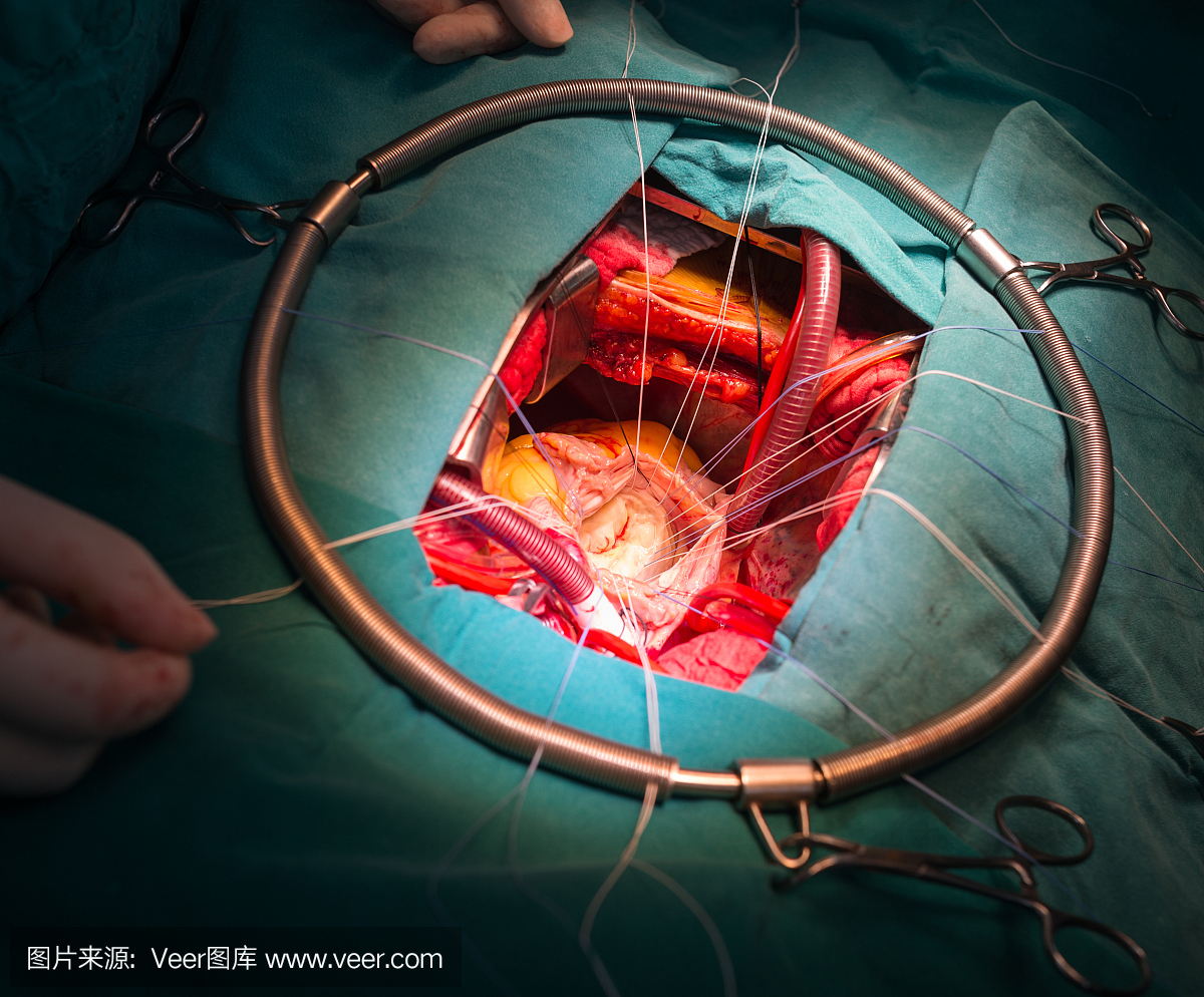 风湿性二尖瓣狭窄