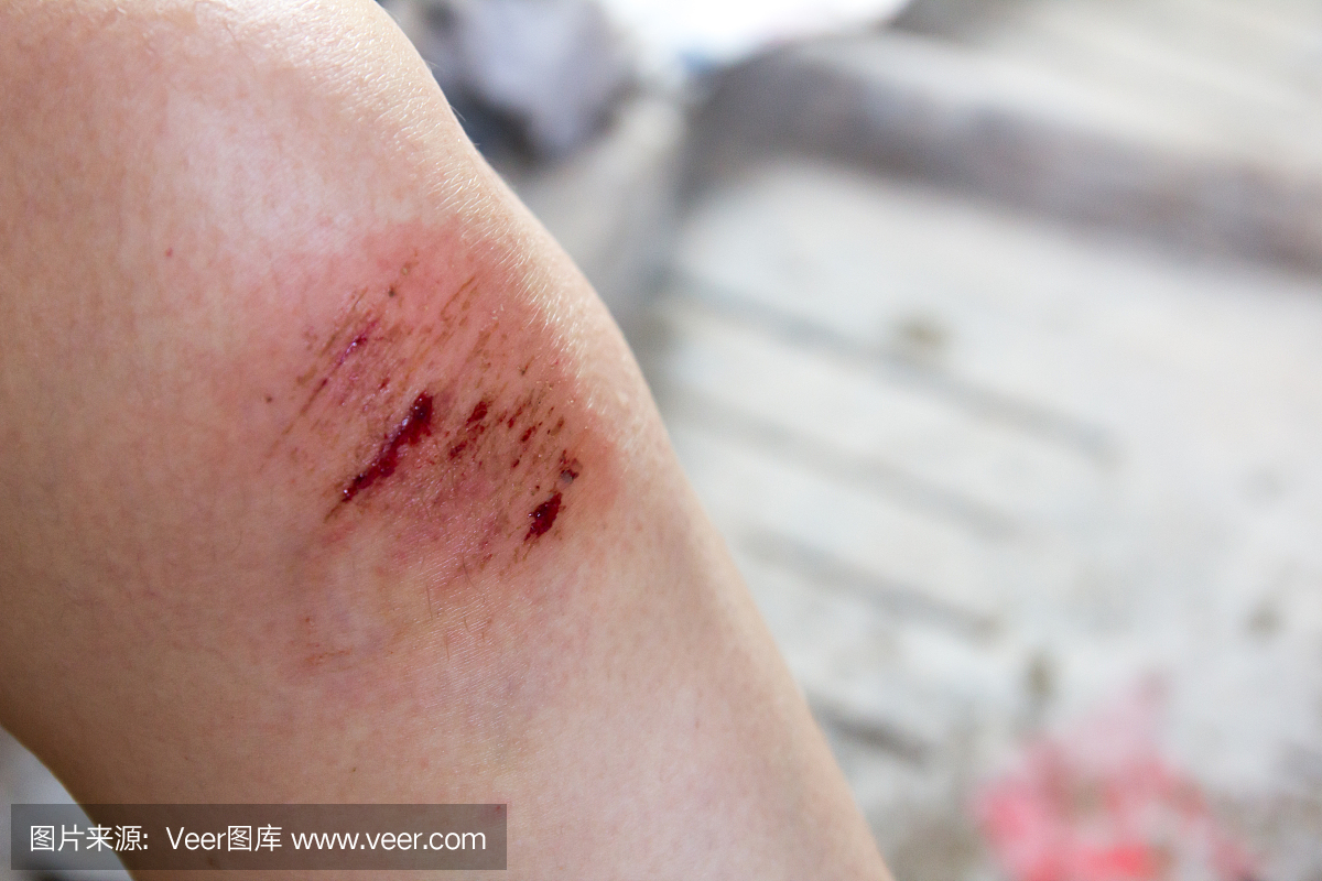 在女人的膝盖背景上受伤的伤口