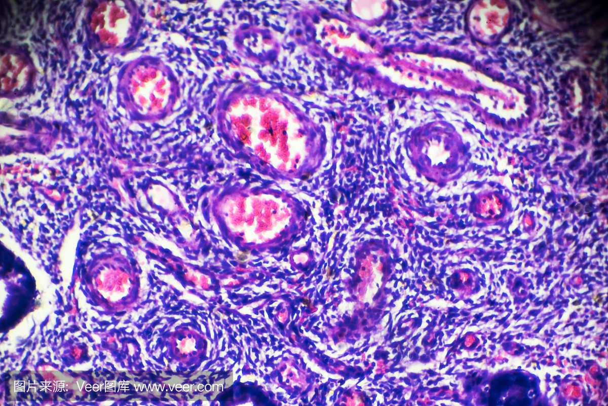 Cervical polyp under microscopy