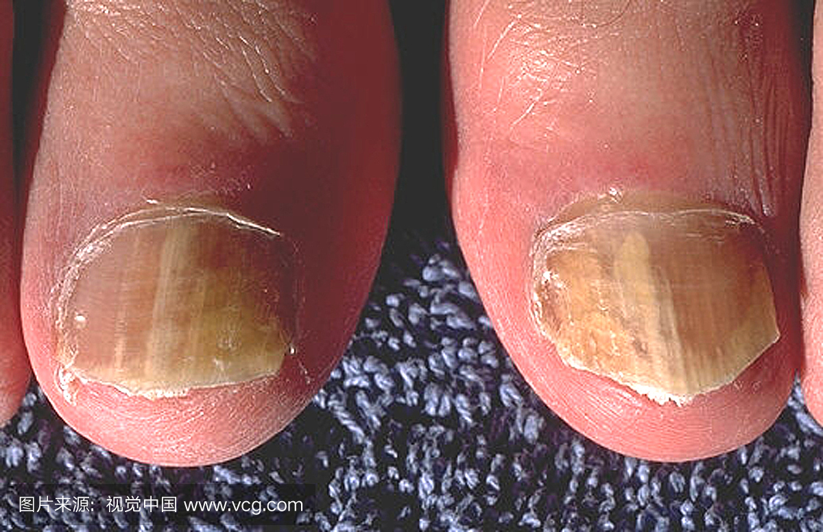 由于红色毛癣菌引起的甲真菌病,左右大脚趾。
