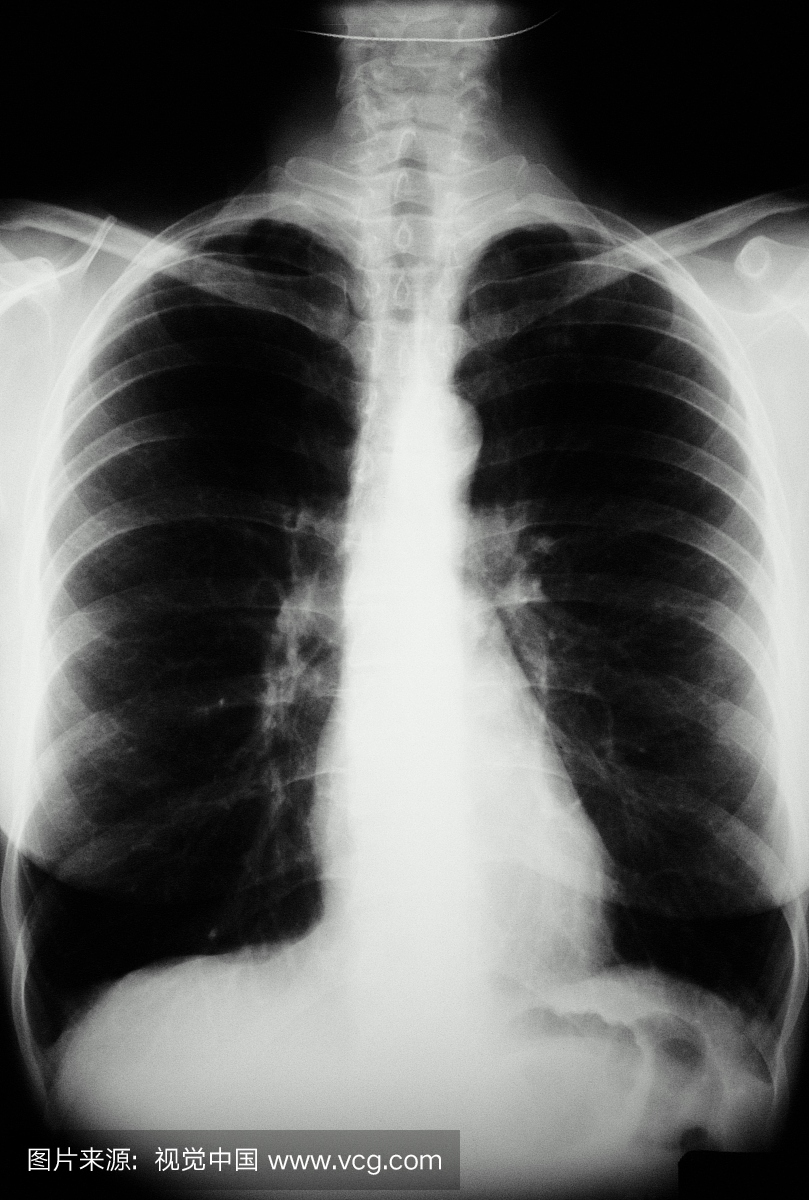 人体结构,仅成年人,垂直画幅,X光片