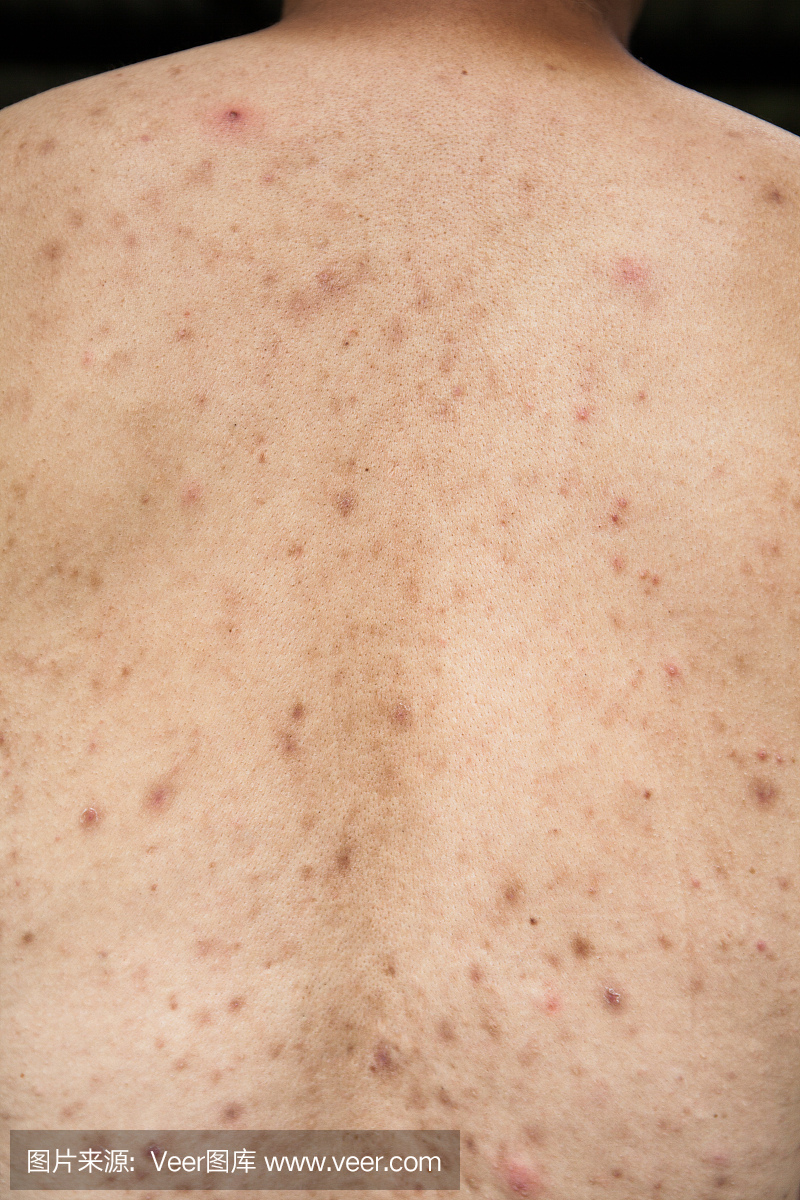 男孩有问题的皮肤和痤疮疤痕在后面