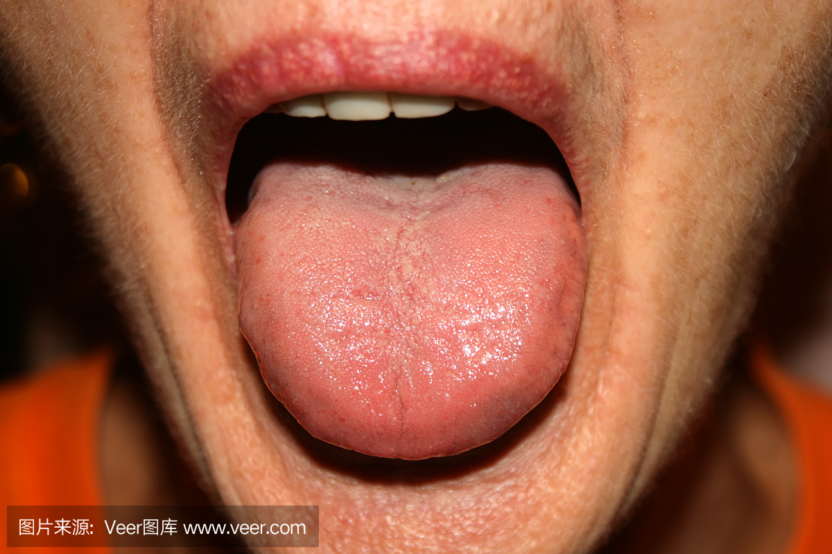 舌头念珠菌病。白色涂层。画眉。