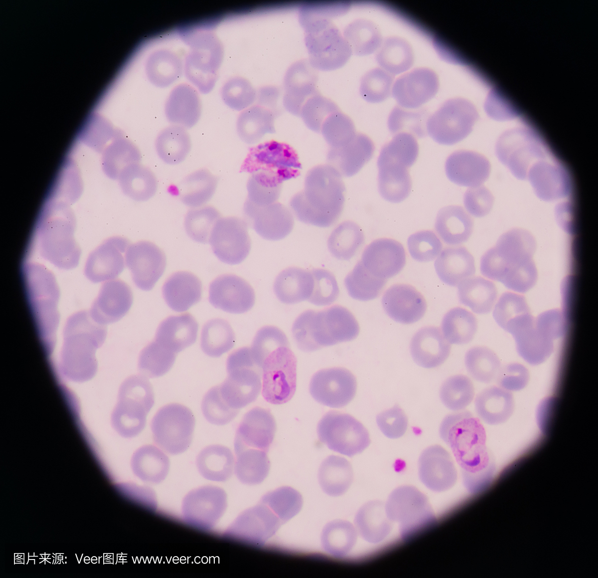 疟疾寄生虫血片为疟疾色素。