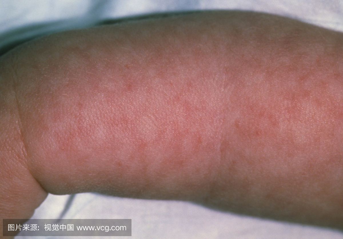 婴儿女孩手臂从病毒性脑膜炎显示皮疹