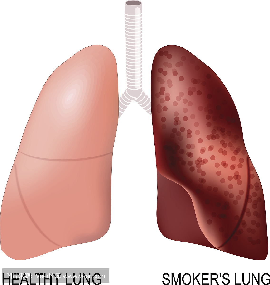吸烟者的肺和健康的肺