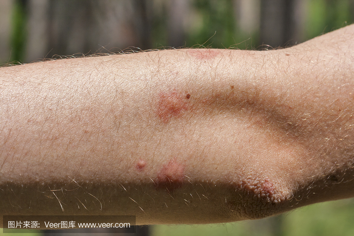 蚊子叮咬人类肘部的痕迹
