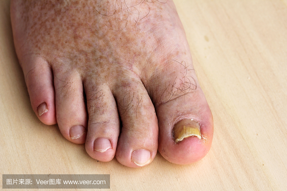 指甲真菌在脚趾甲和皮肤斑点