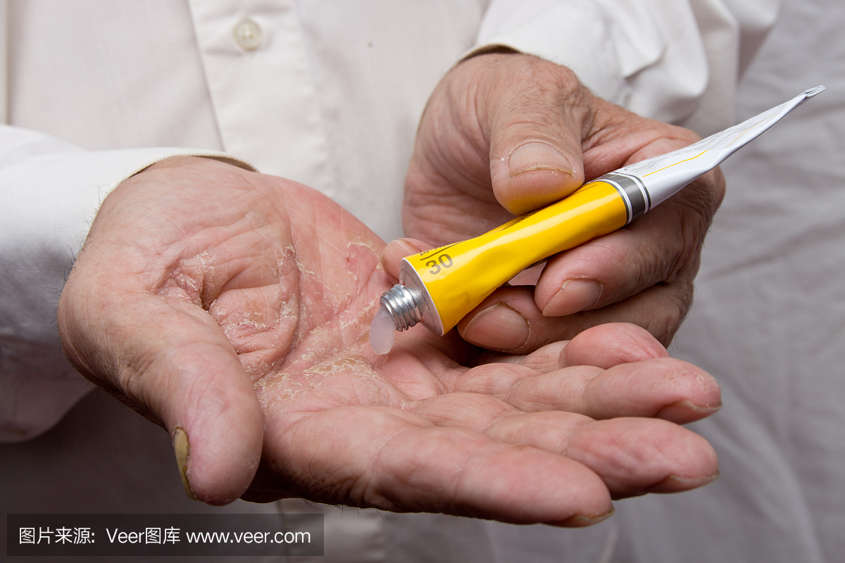 湿疹在手上。药膏在老人的手上。将软膏和润肤
