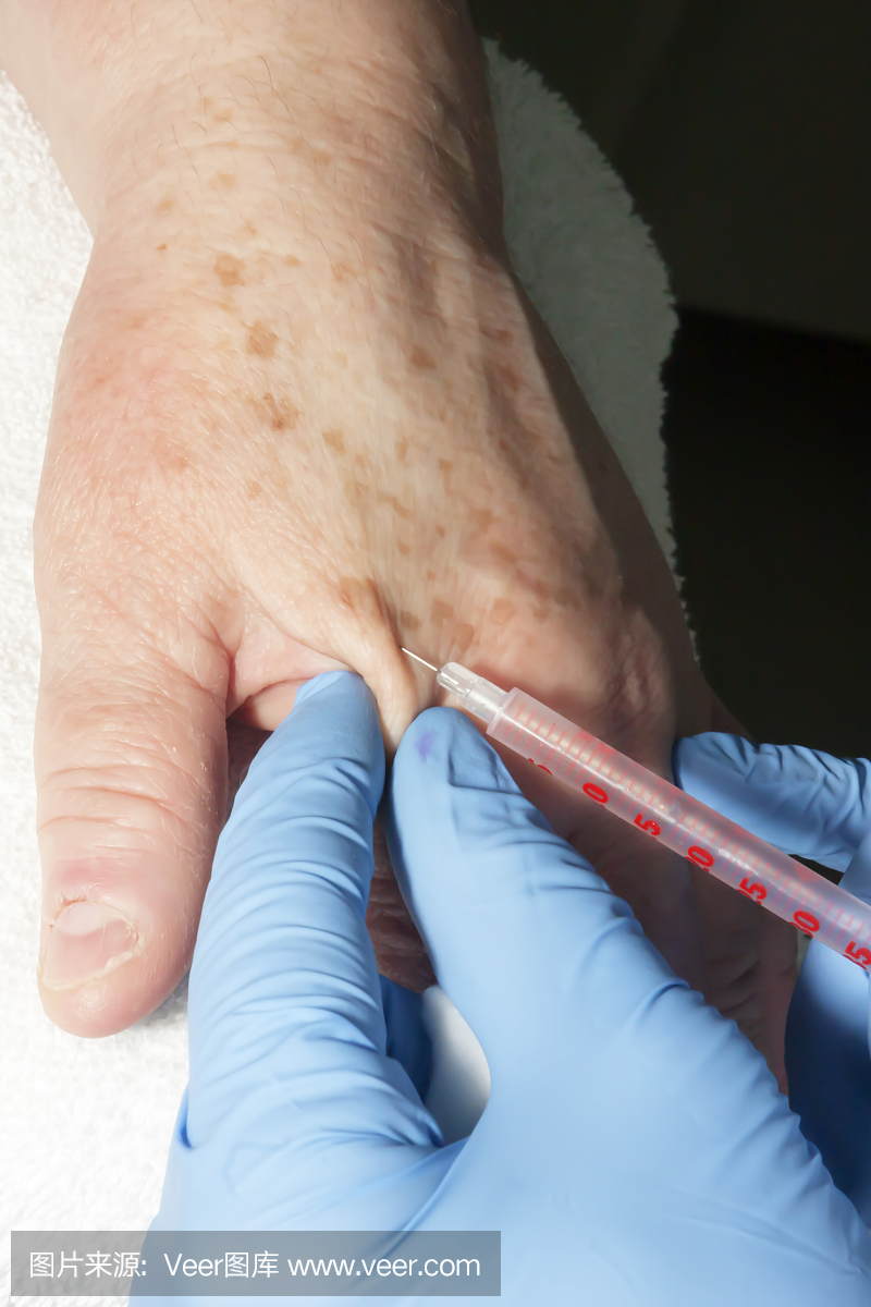 微型皮肤病手术 - 手部局部麻醉